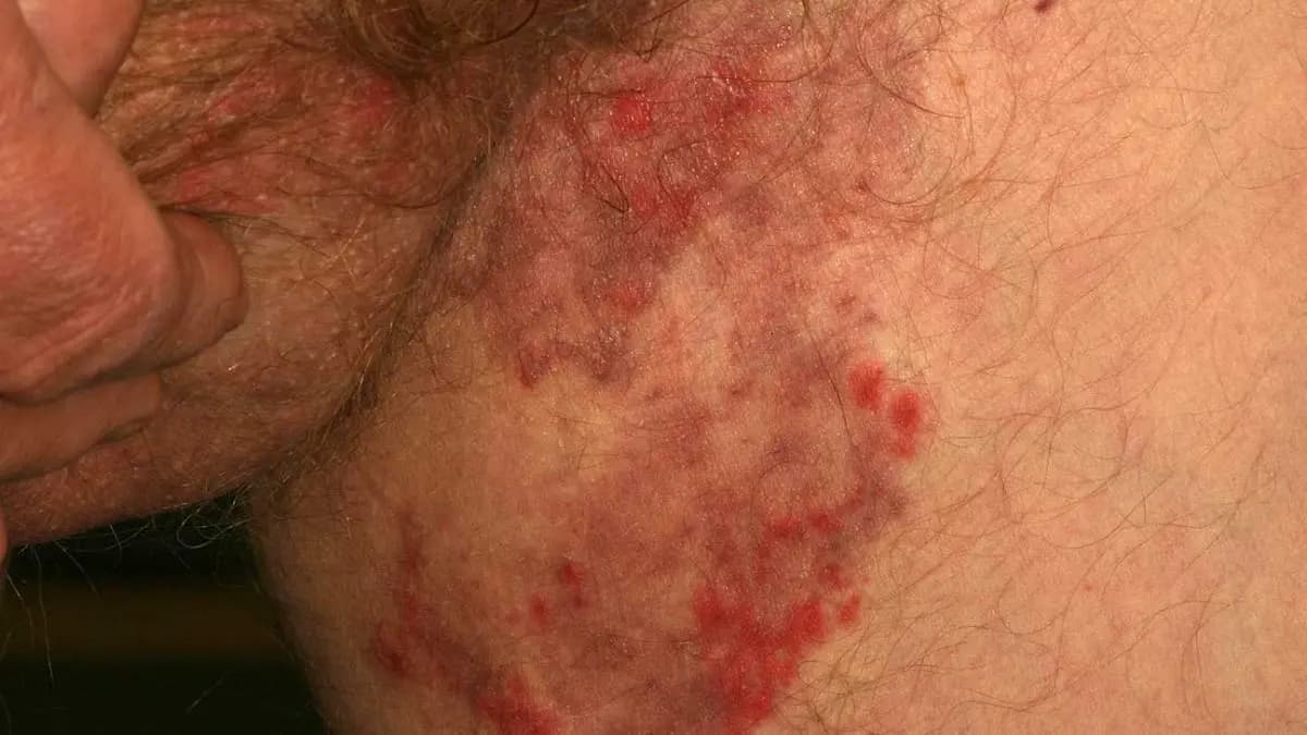 Five Home remedies to get rid of Fungal Skin Infection during Summer
