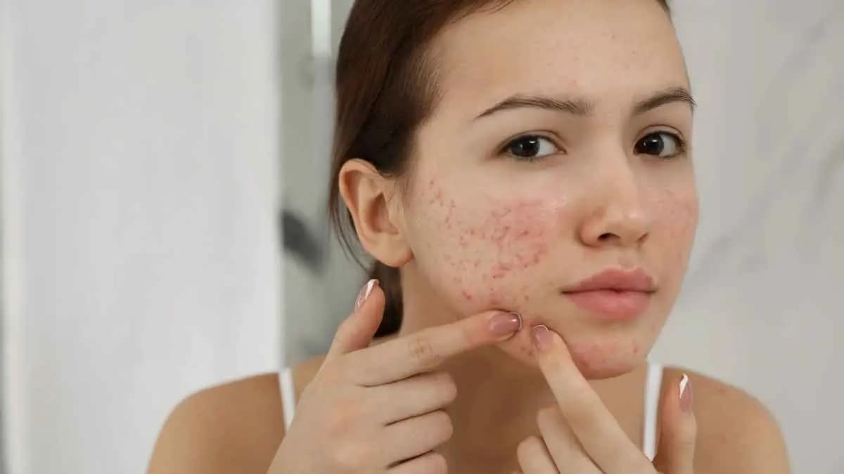 this home made natural remedy can prevent acne problem during teenage cleans and detoxify the body also lif 