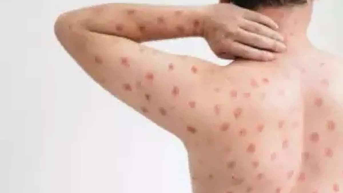 Researchers develop optical biosensor for rapid monkeypox detection gnr 