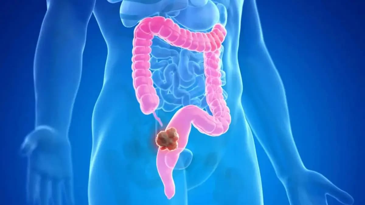 Number of Colon cancer patients are increasing in India