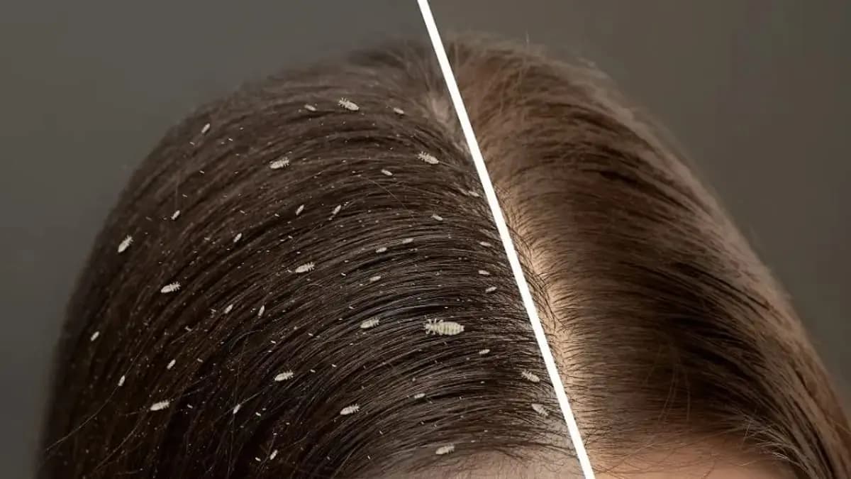 lices are dengerous for your hair health here some easy home remedies can be good lif