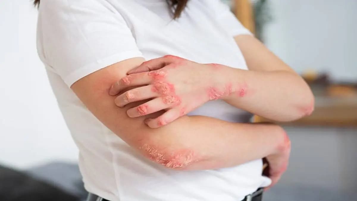 Autoimmune disease Lupus a tale of a village school teachers battle and victory