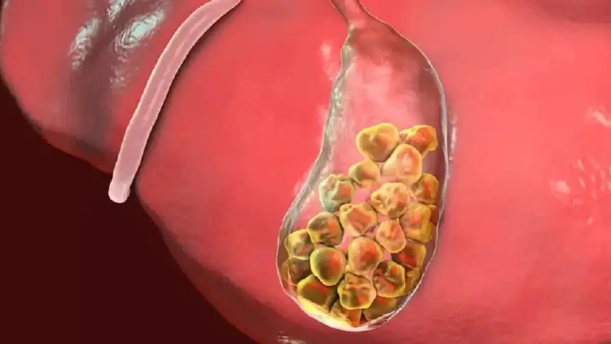These habits can create stones in your gall bladder 