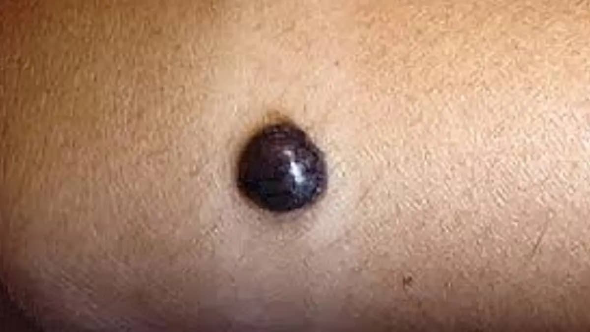 Moles on private part have inner meanings
