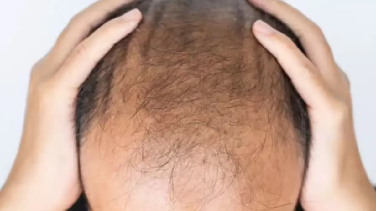 Serum that restores hair in 20 days Scientists big claim