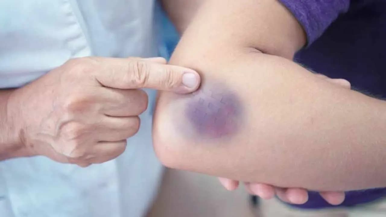 Unexplained Skin Bruising: Causes Vitamin Deficiency And When To See A Doctor