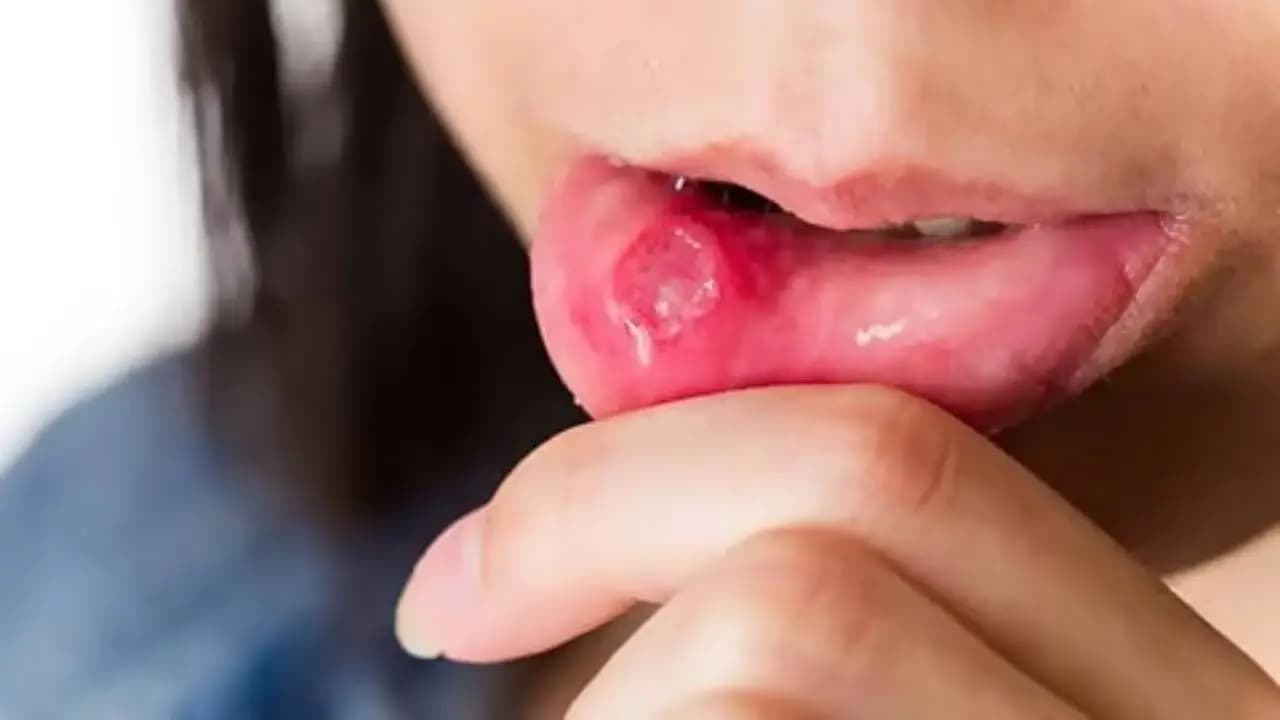 Early Signs of Oral Cancer: These symptoms You Shouldn not Ignore