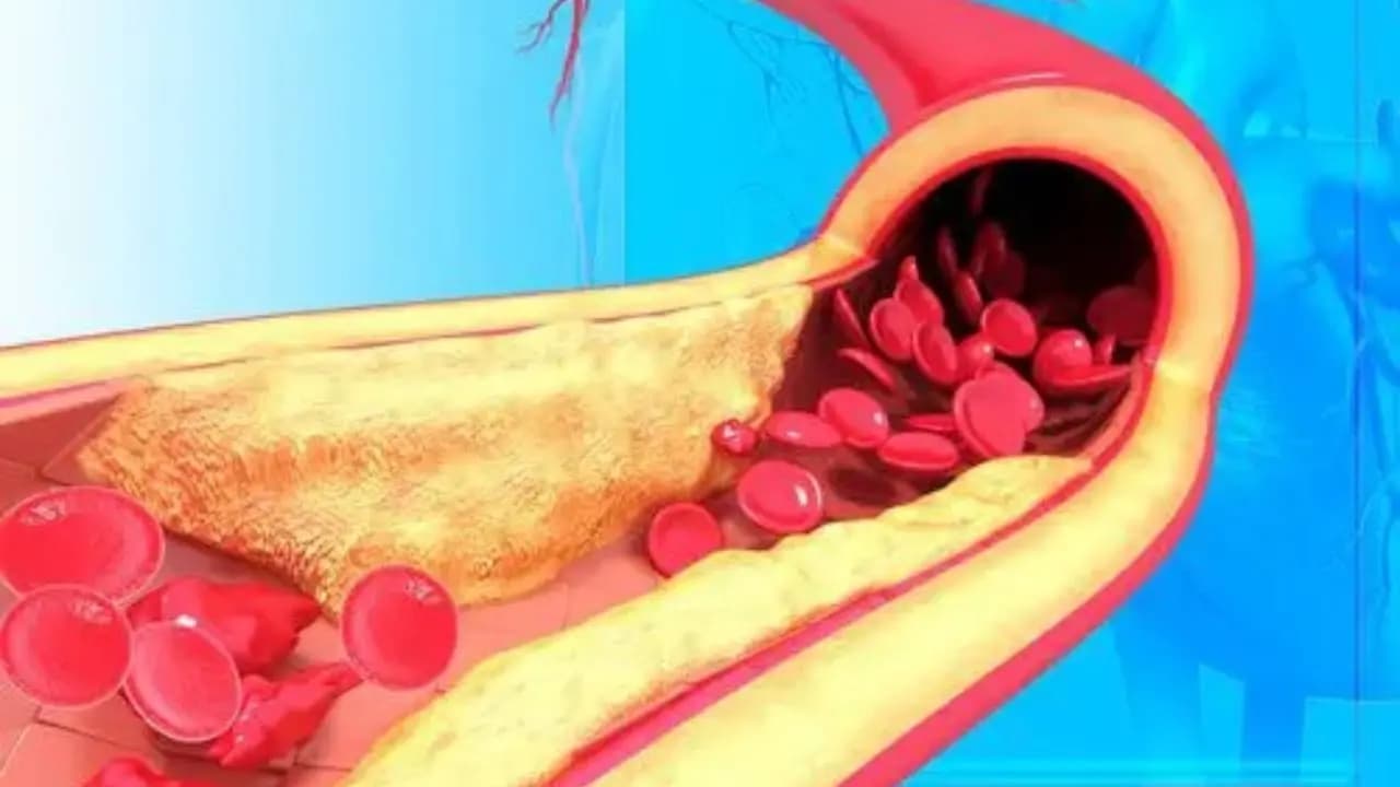 High Cholesterol Risks