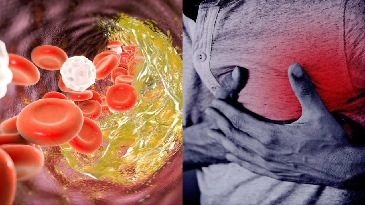High Cholesterol Signs