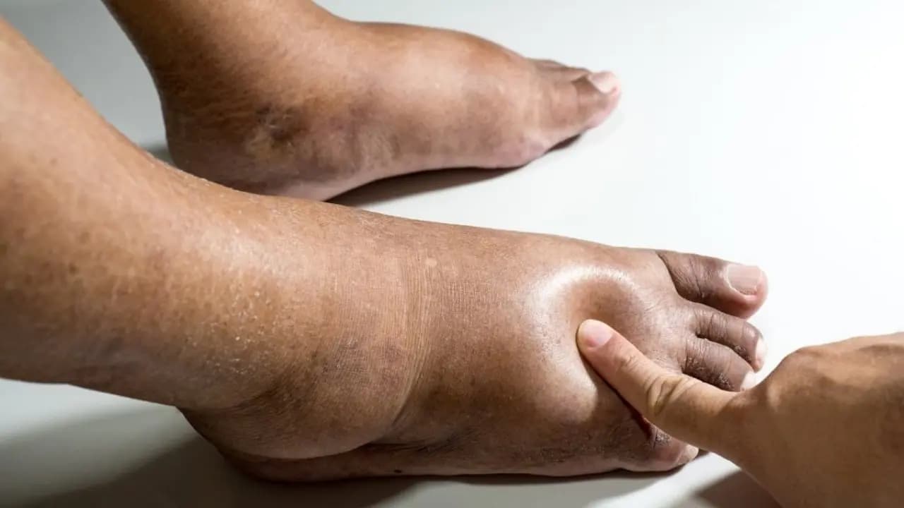 Sudden Body Swelling Causes: Edema Could Signal Heart Failure or Kidney Disease