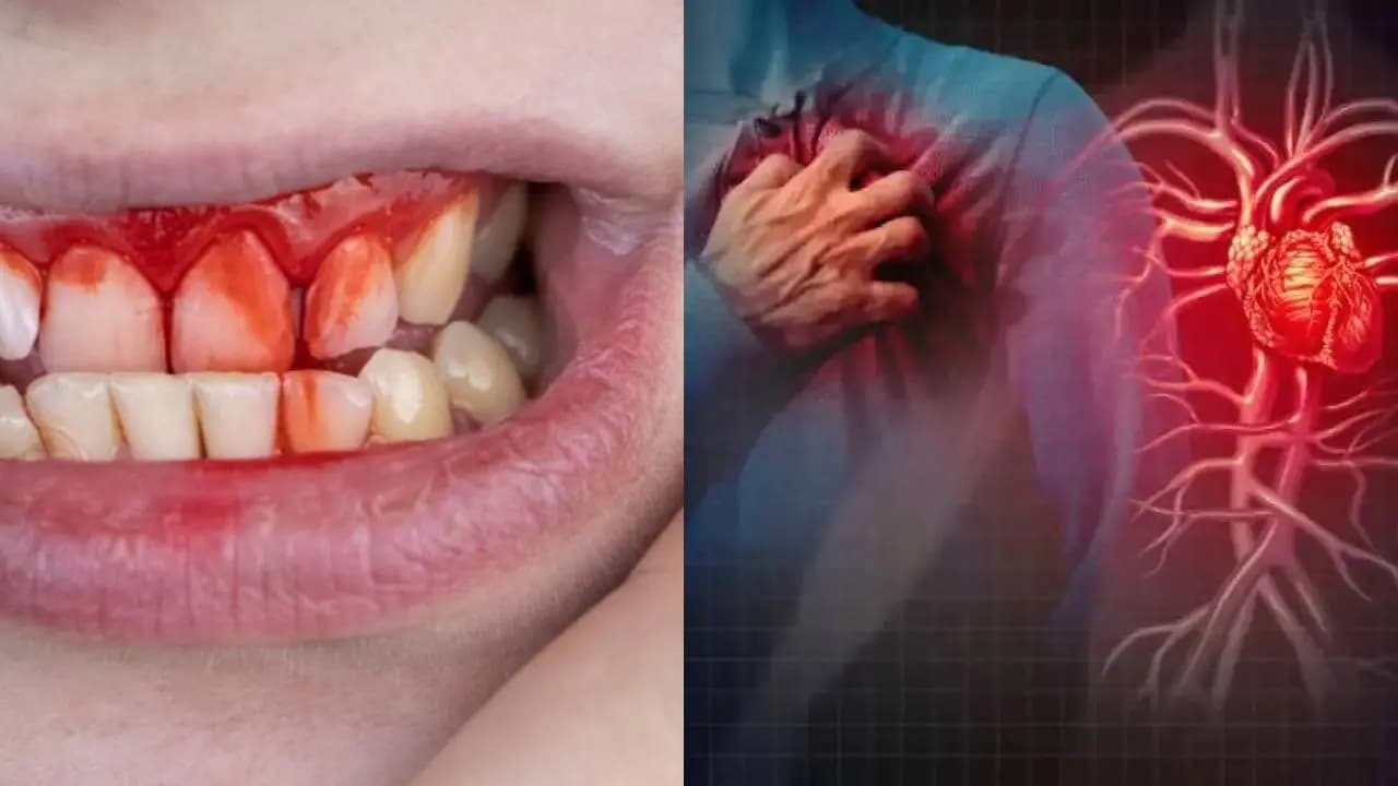 Gum Bleeding Bacteria Linked to Heart Infections New Study Warns