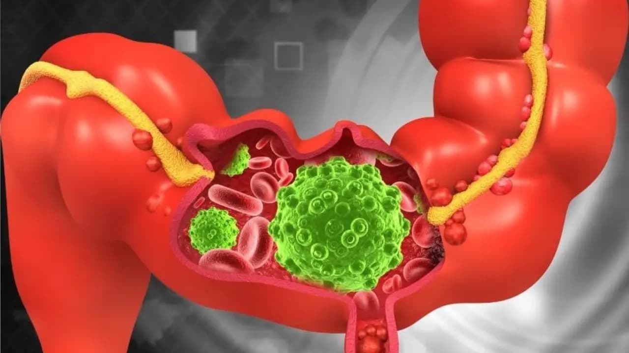 Colon Cancer Symptoms: How to Spot Signs vs Piles Early