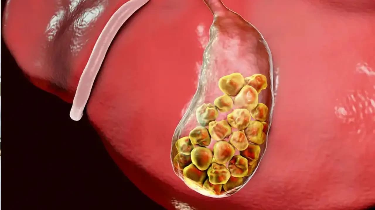 Why risk of gallstones rising even among healthy young people? Doctors warning