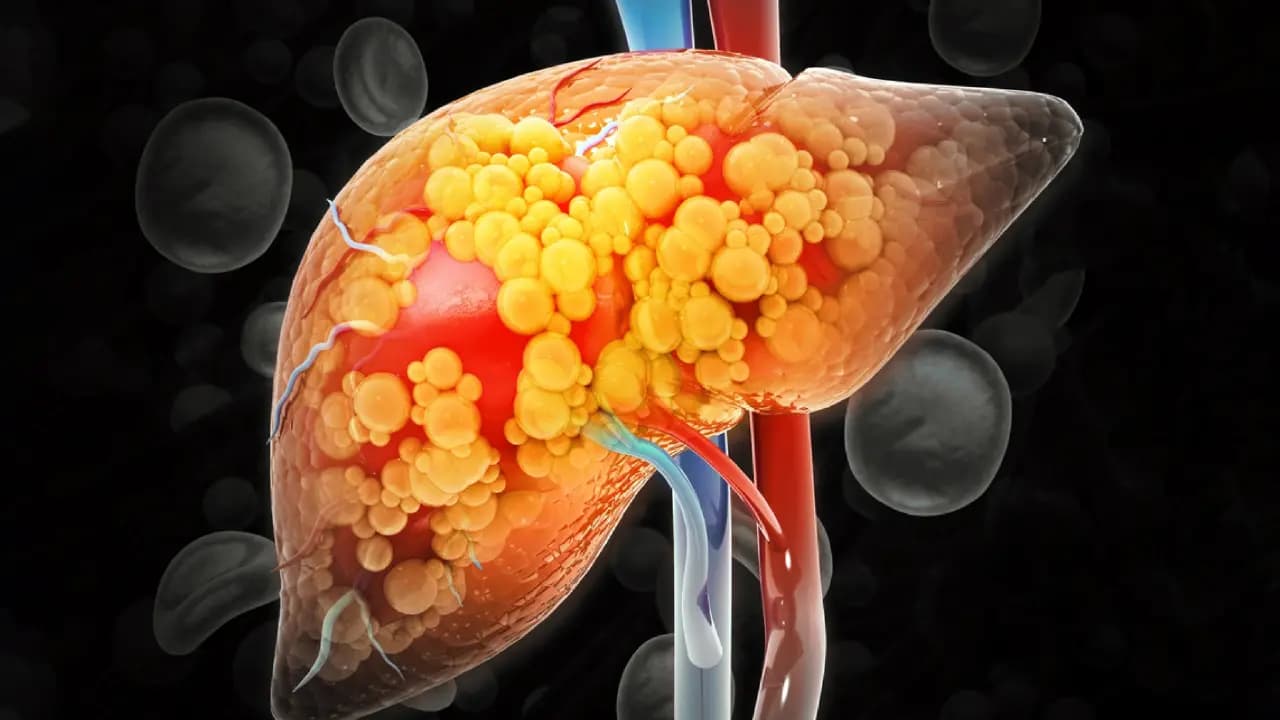 Food for Fatty Liver Cure: Include these 5 foods in your diet to reduce fatty liver; find out what doctors recommend