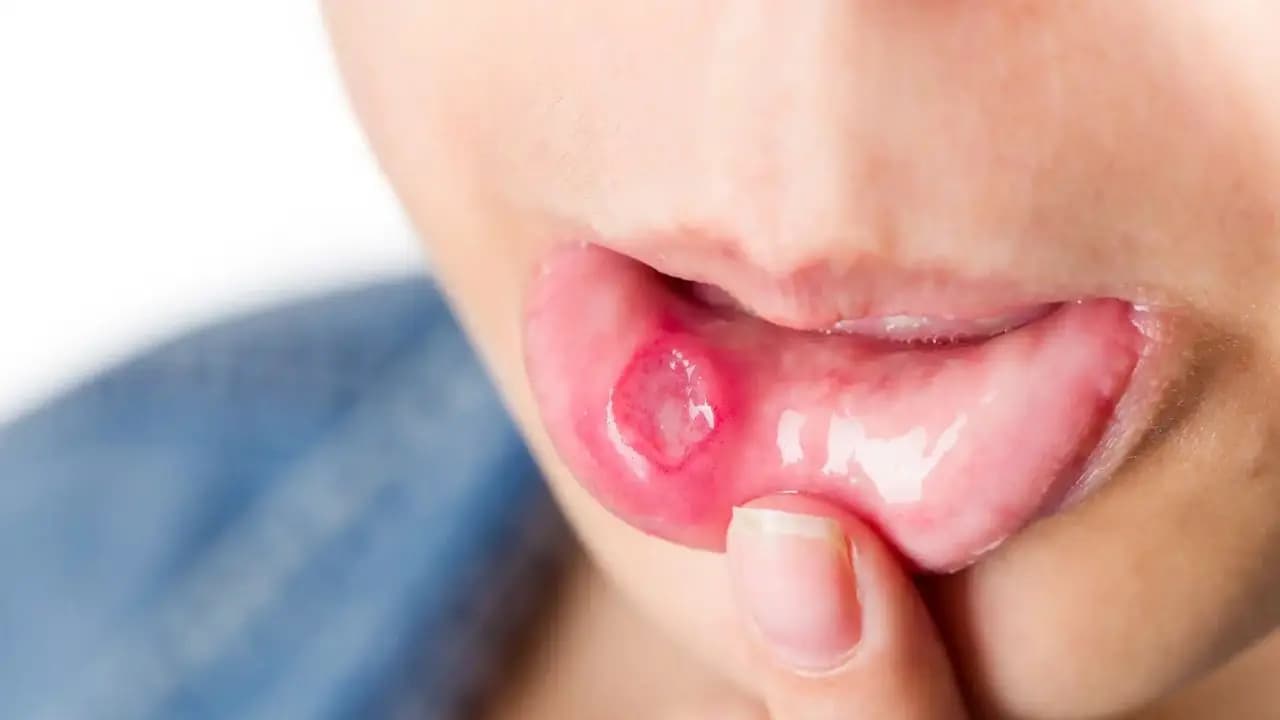 Mouth ulcer remedy: use these 7 things to get relief