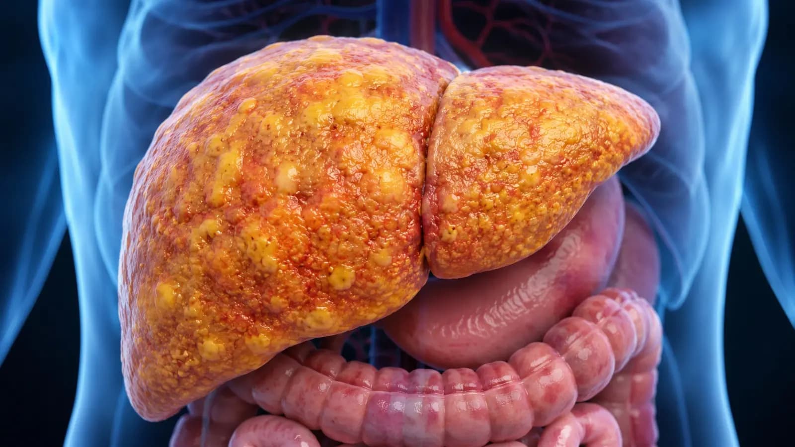 Fatty Liver Prevention: 7 Best Fruits to Reduce Liver Fat