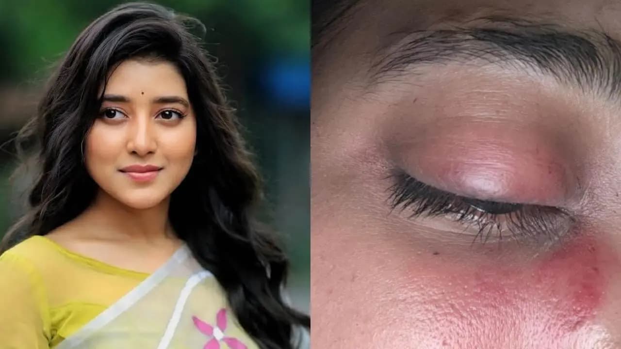 Aratrika Maity have eye injury during the shooting of Jowar Bhanta 