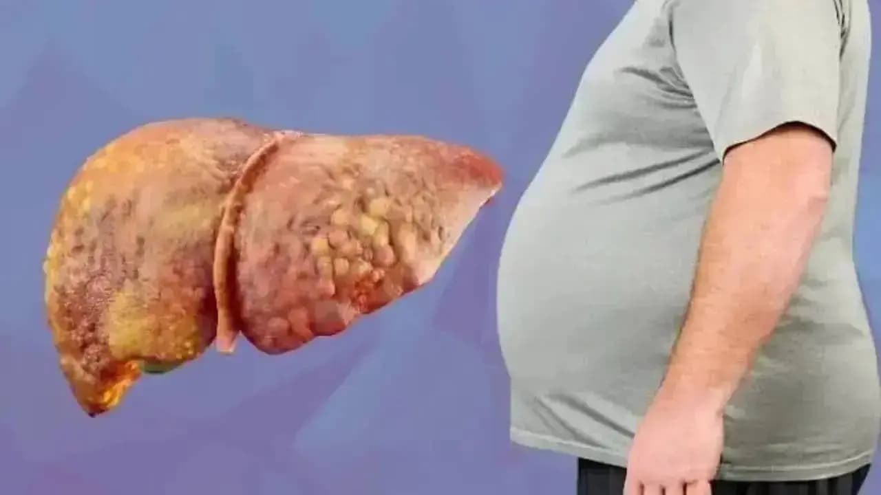 Fatty Liver Disease in Non-Alcoholics: Key Causes Risks and Prevention Tips