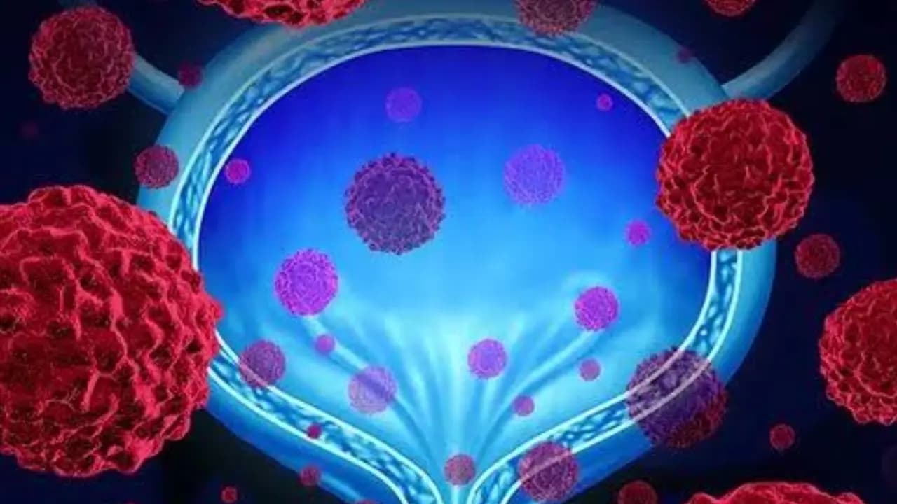 Bladder Cancer Detected Through a Painless Urine Test?