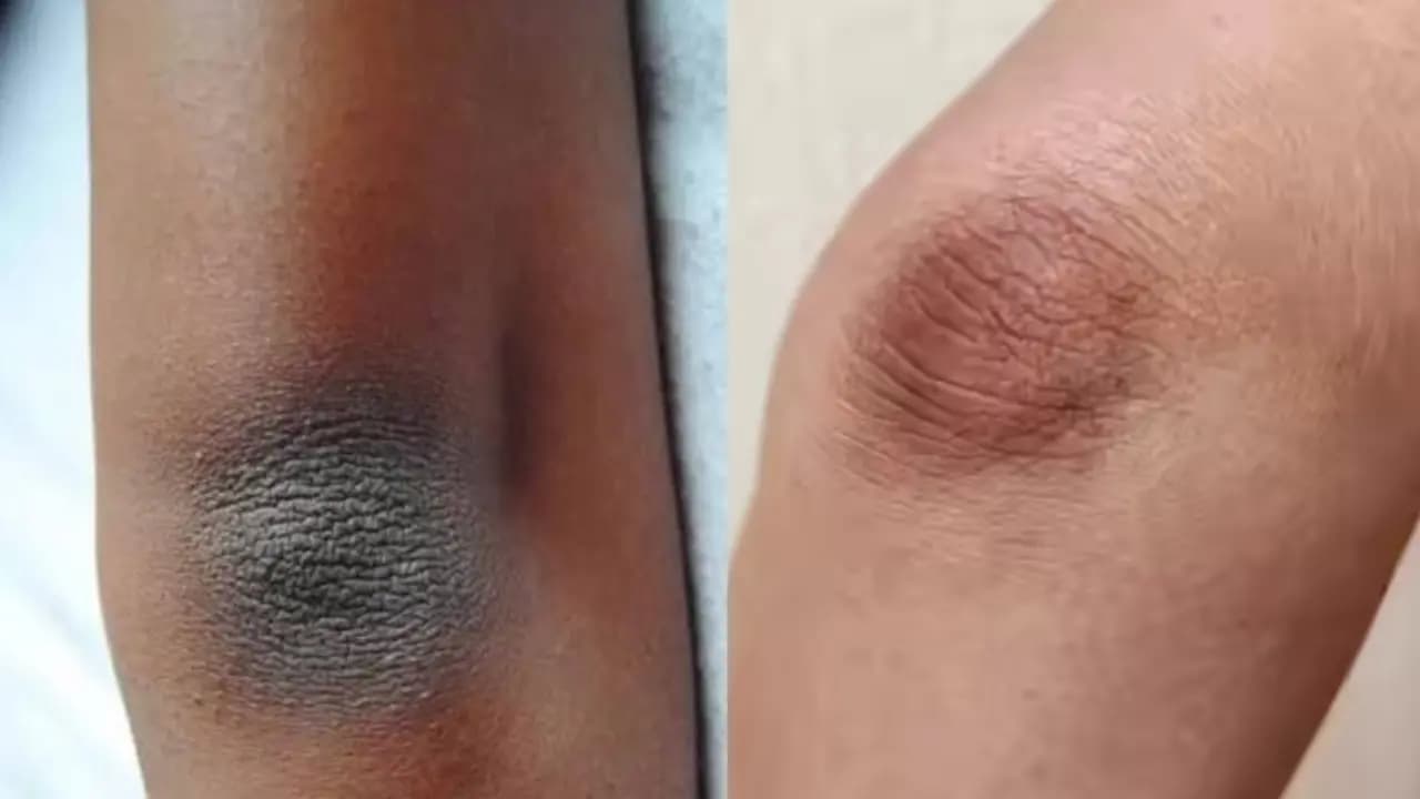 3 magical Homemade Mask for removing Stubborn Black Patches on Elbows and Knees