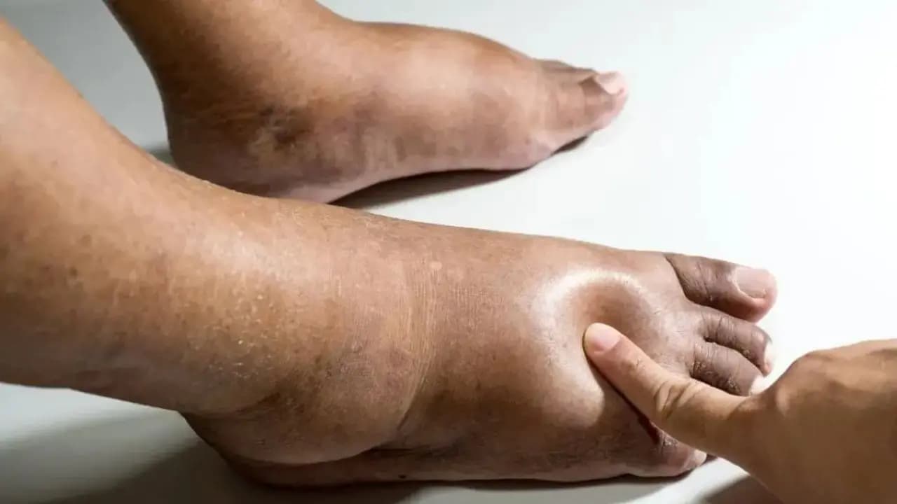 Kidney health: these signs become visible when you have damaged kidneys