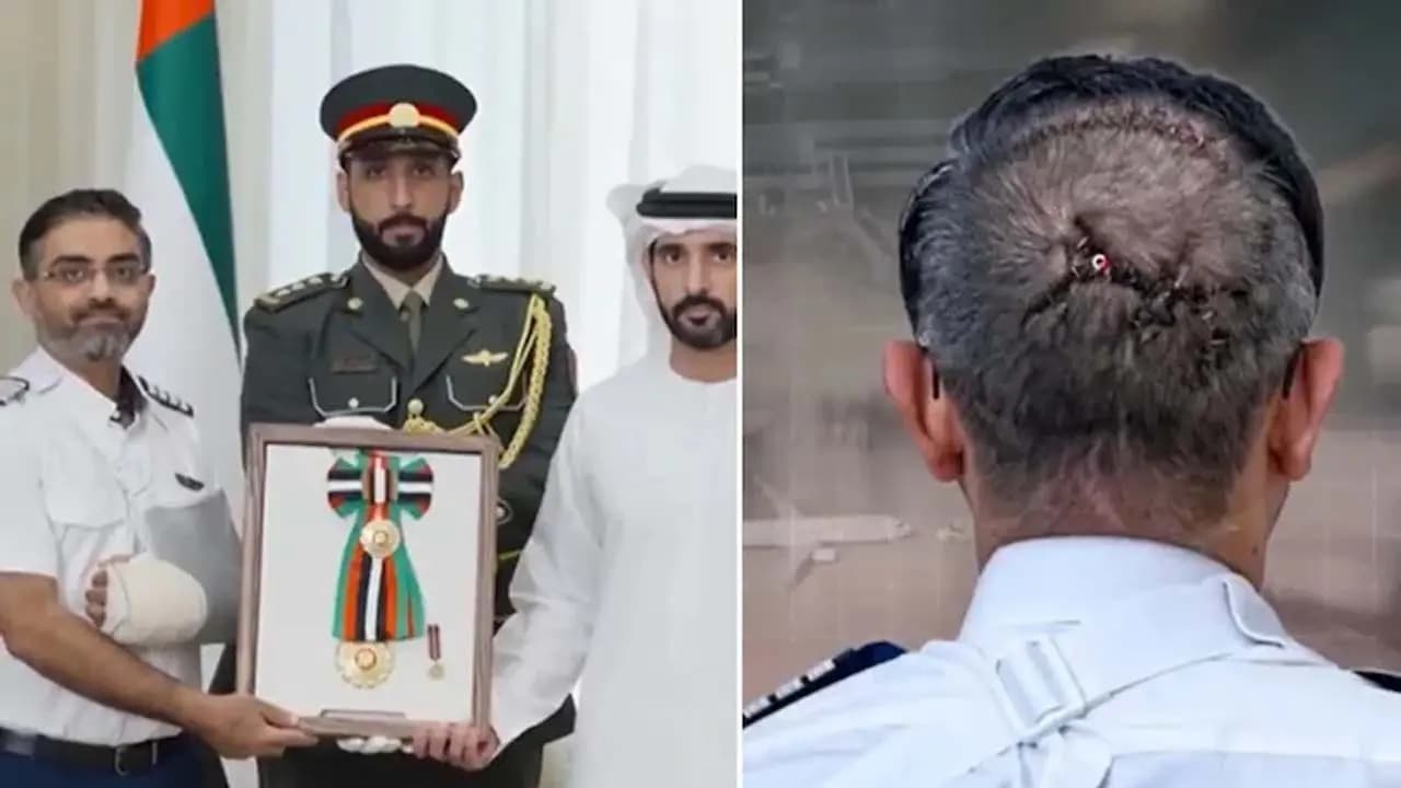 A long stitch a hole still visible at the back of his head the injuries of Indian pilot Smith Machhar who flew for Flydubai are now on full display