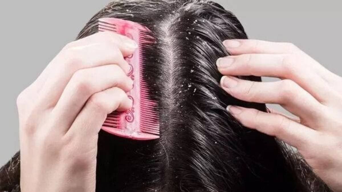 do not do these mistakes to prevent dandruff problem lif