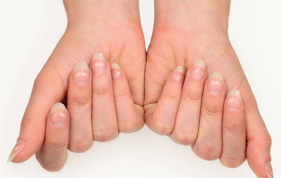white spot on nail may be dangerous what is cause and treatment of it LIF