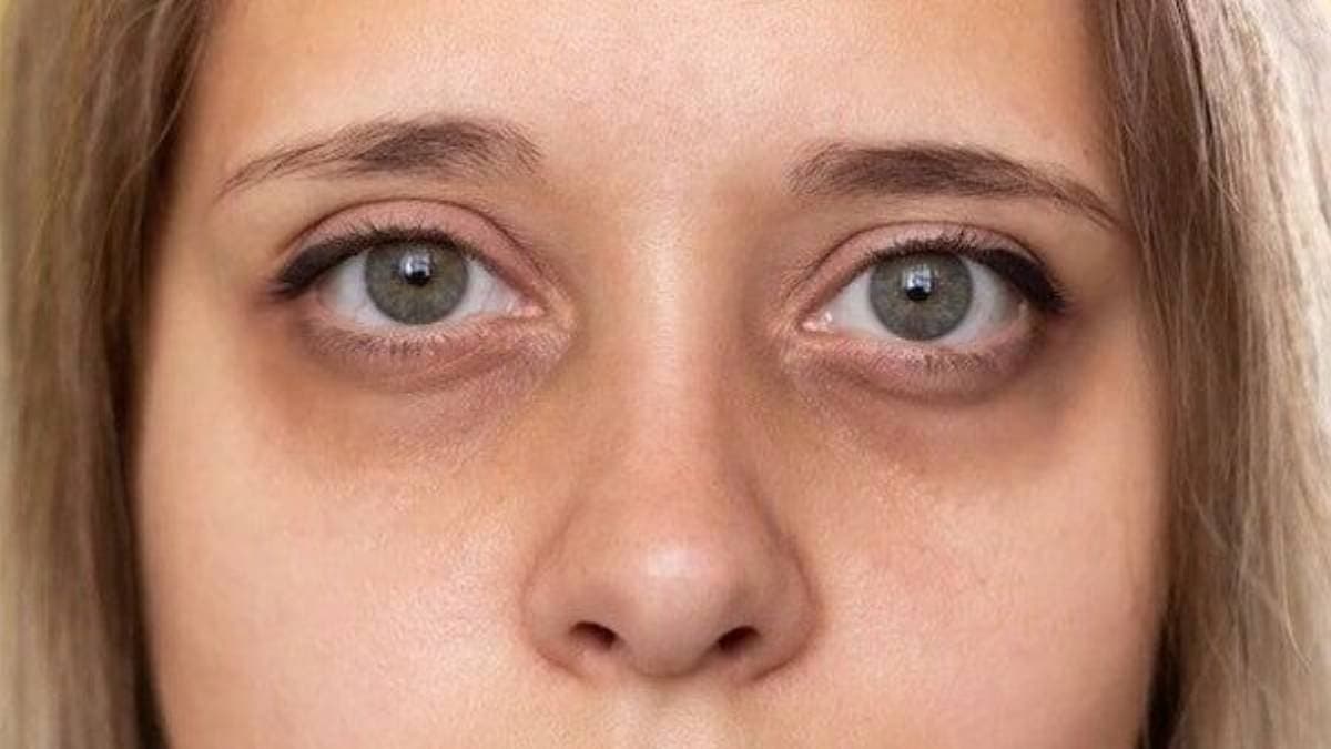 Under eye Dark circles can indicate these serious health problems