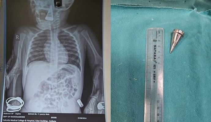 Child care at Kolkata Medical College and Hospital