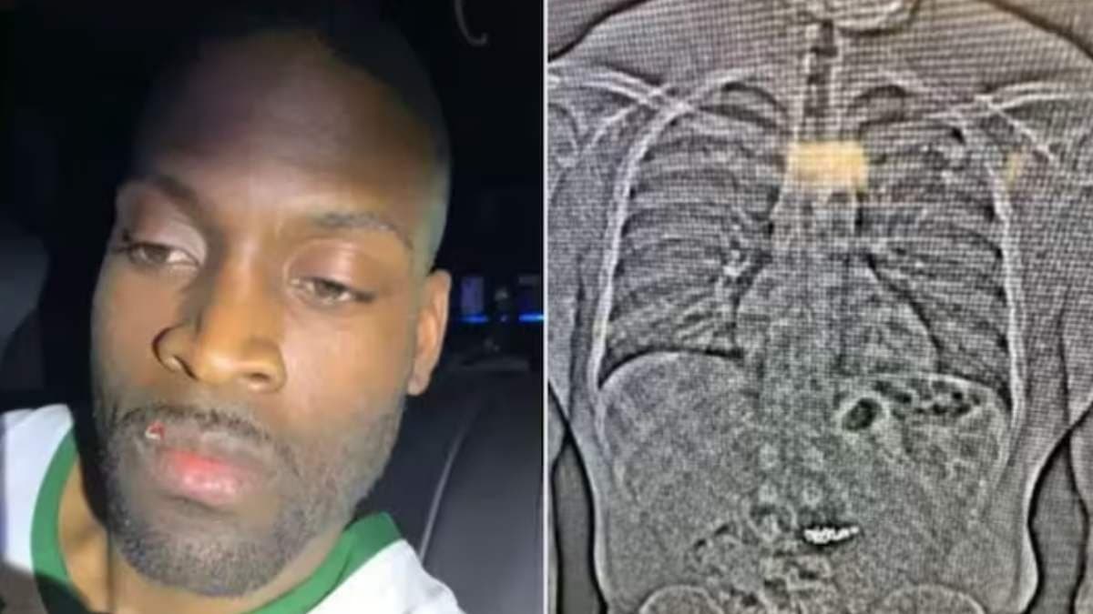 US man swallows earrings worth rupees six crores