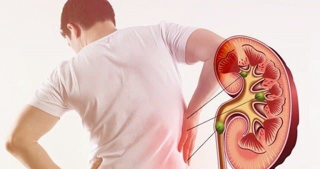 THESE 5 foods may prevent kidney stone formation