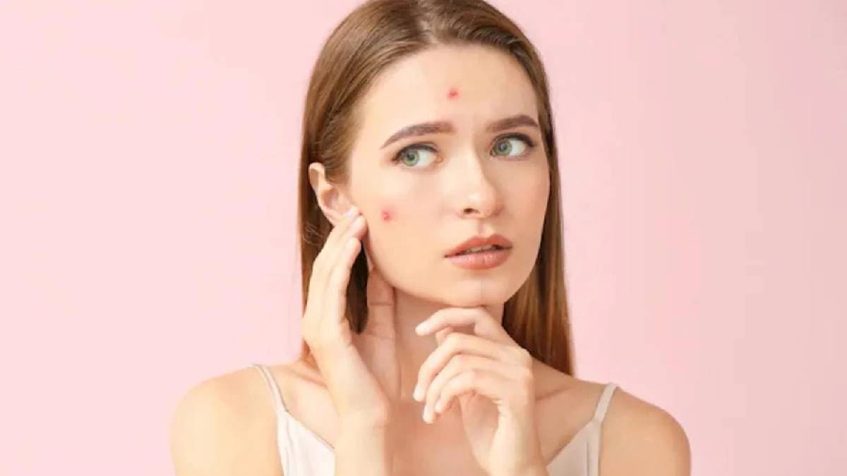 Here Are The 3 Foods That Could Trigger Acne Breakouts