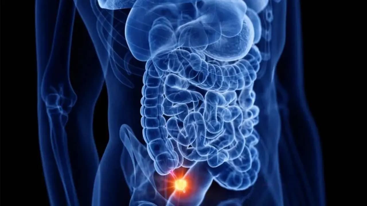 Appendix Cancer Symptoms