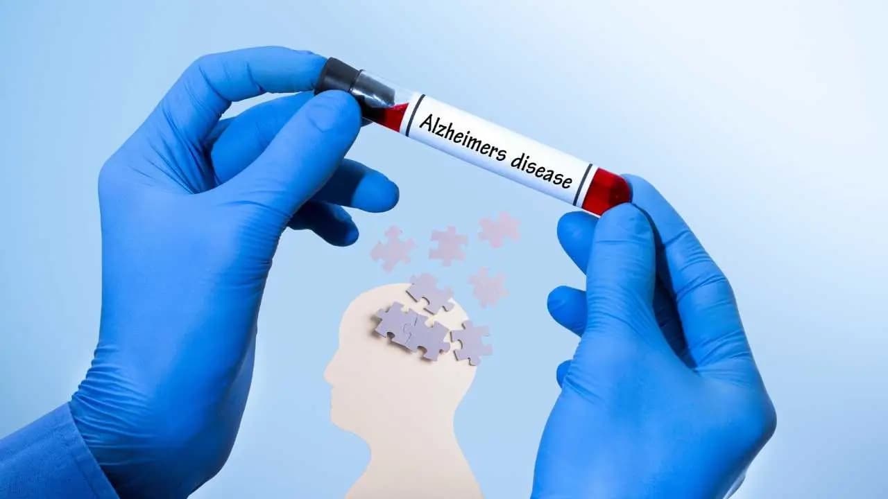 Alzheimer's Disease: New Blood Test Enables Early Diagnosis Without PET Scans
