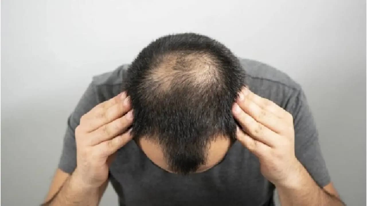 Pumpkin Seed Oil for Male Pattern Baldness: Study Highlights Hair Loss Benefits