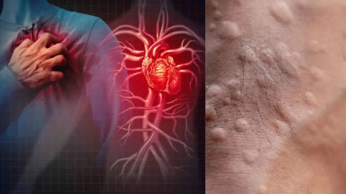 Heart Attack Symptoms: These warning signs of heart diseases appear on skin