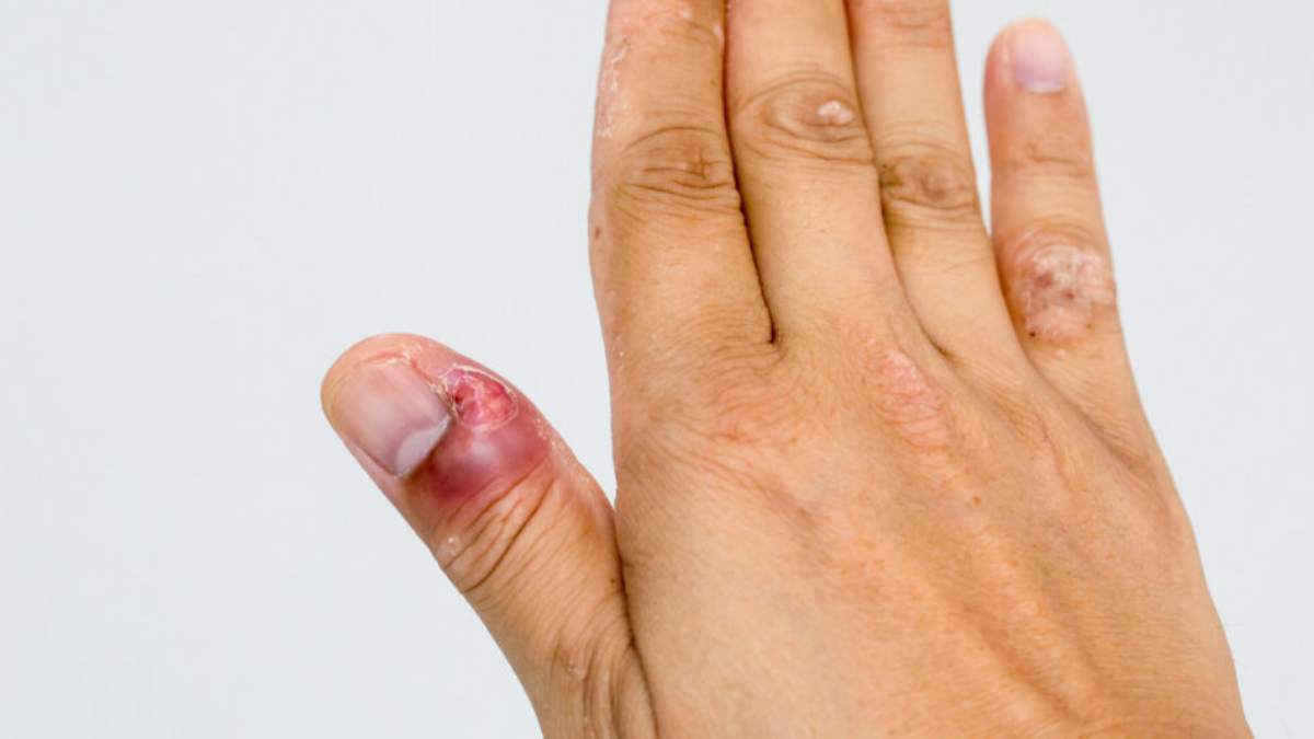 Paronychia is became painful and infected it treated with less water use on your fingers