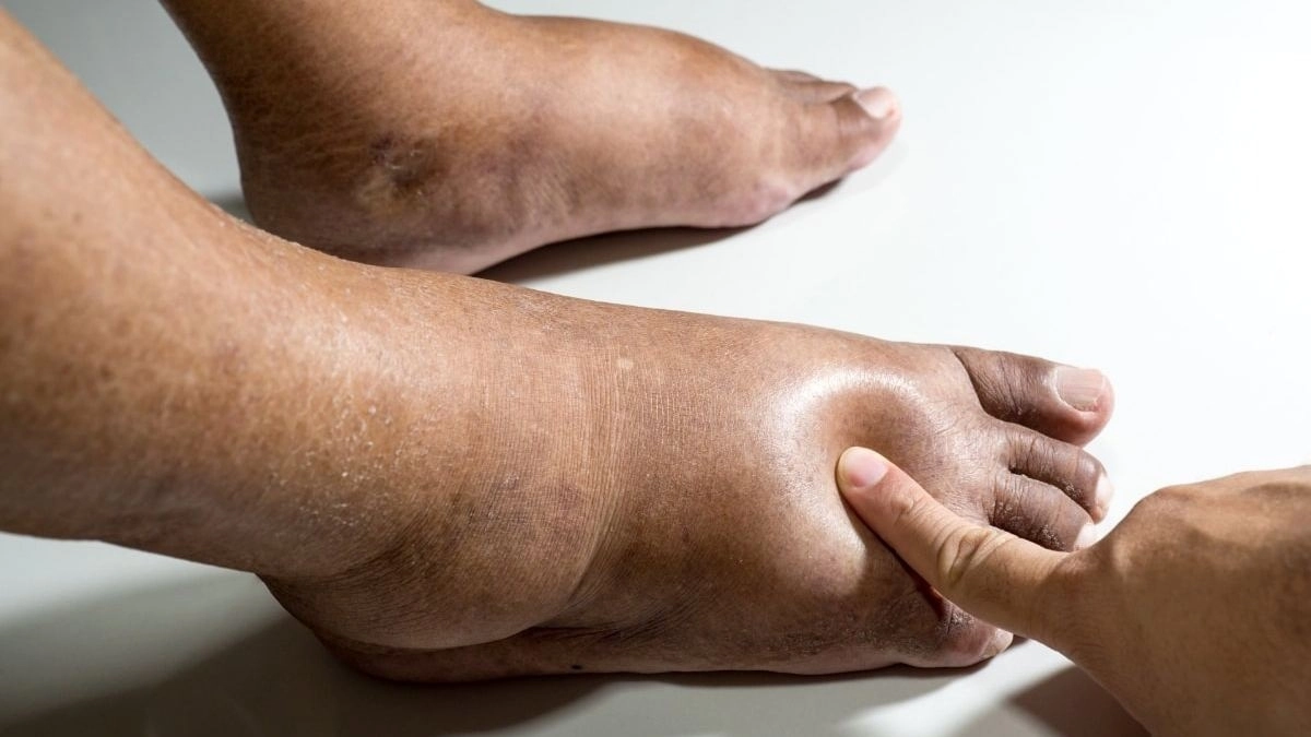 How to prevent Swollen feet or Foot edema with Home Remedies