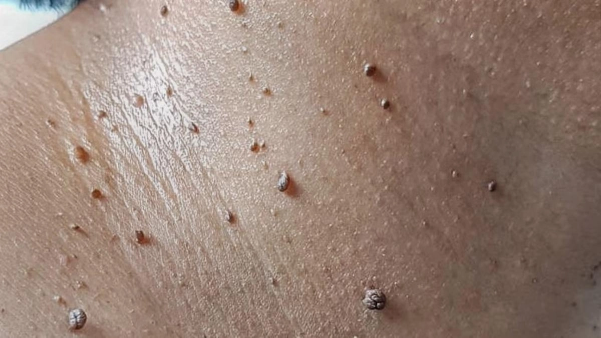 Symptoms of Skin Cancer and diagnosis